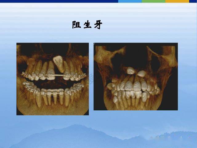 牙体牙周正常解剖及常见病x线表现