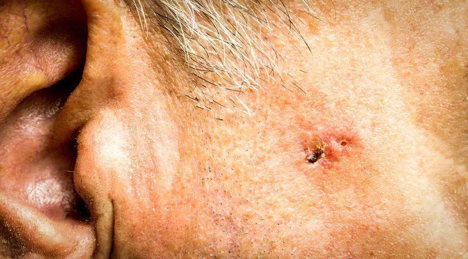 如何区分老年斑和皮肤癌生姜大蒜能预防老年斑吗