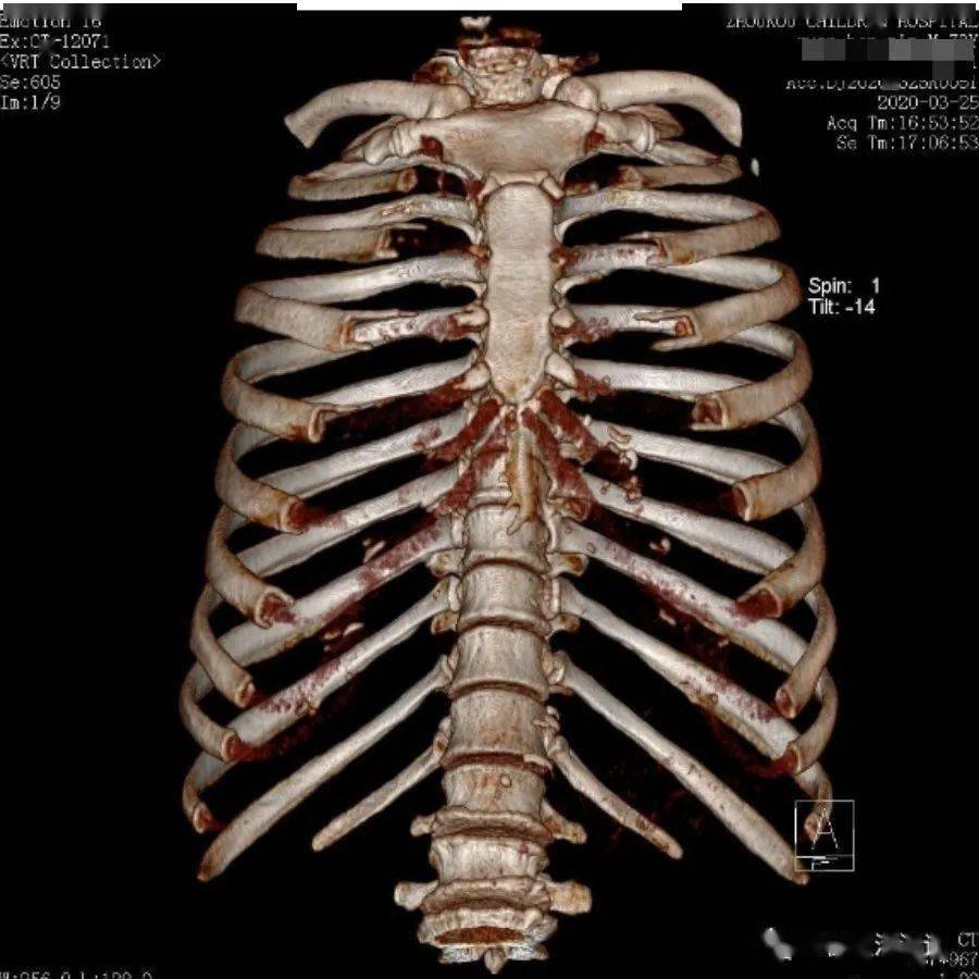 胸部外伤病人ct扫描后做三维重建的意义