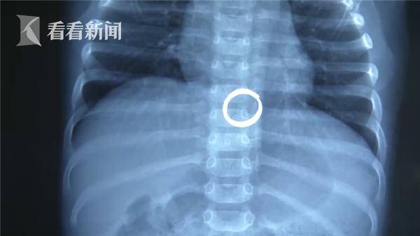 1岁女童哭闹不止医生从胃里取出直径2cm金戒指