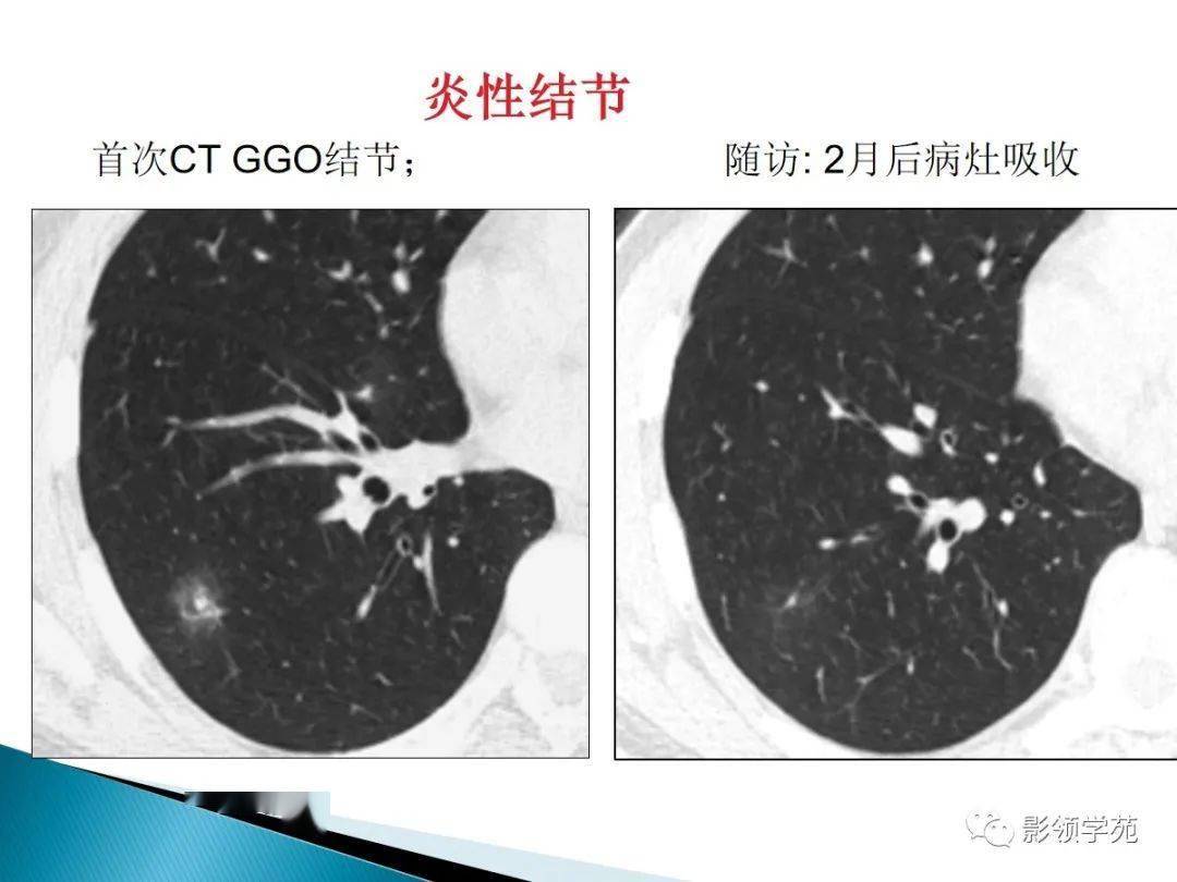 空泡征出现率高,>50%; 右肺上叶舌段多个结节内可见透亮区 3.