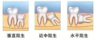 为什么拔智齿价格有的贵有的便宜?