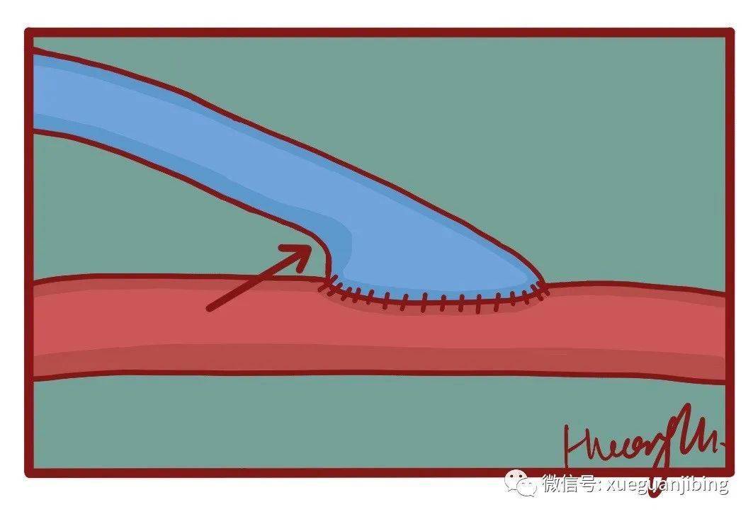 血管端侧吻合术的一些小结