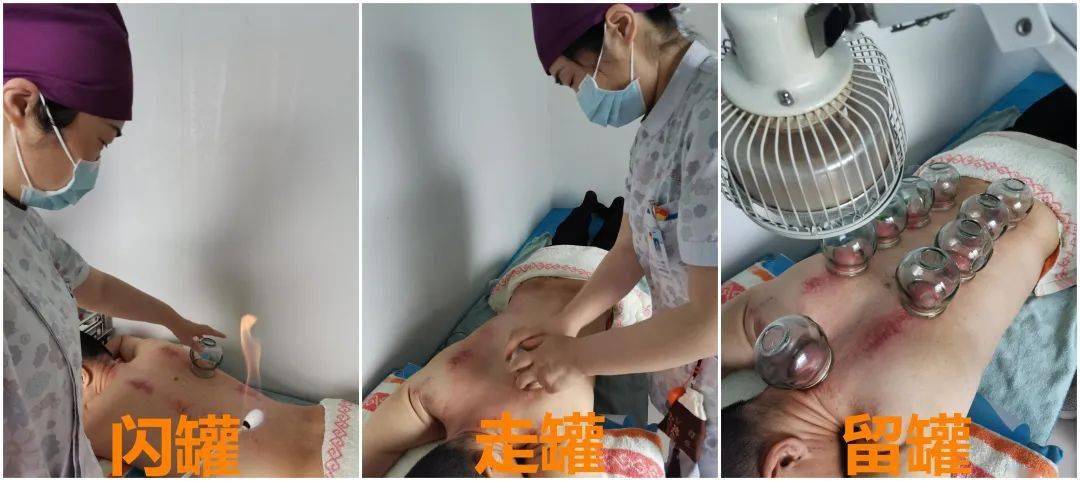 中医特色 | 黄梅雨季,"平衡火罐"助您提神醒脑,疏经通络