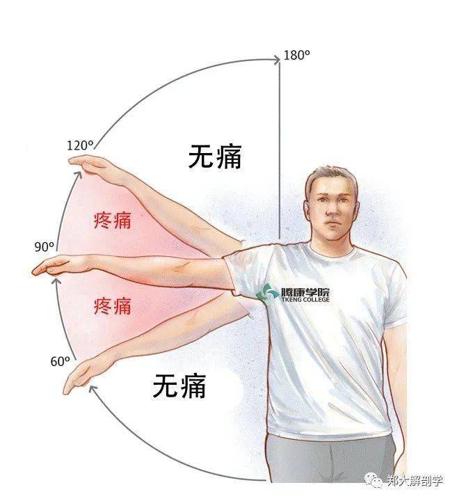 肩峰下撞击综合征