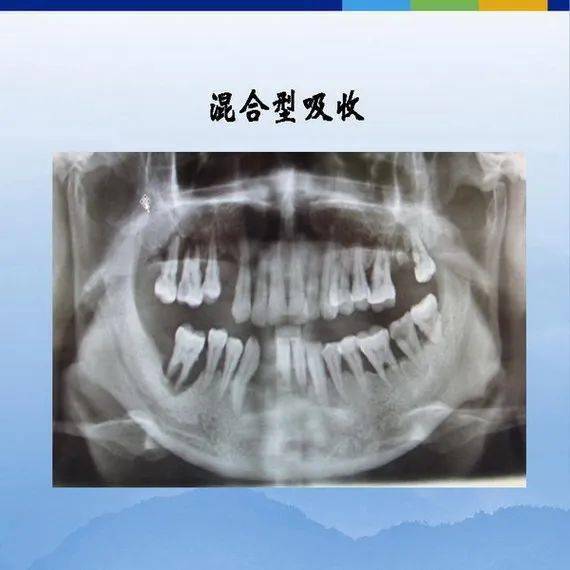 牙体牙周正常解剖及常见病x线表现