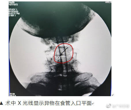 金属|如鲠在喉！深圳一男子食堂吃饭吞下2.5厘米金属针