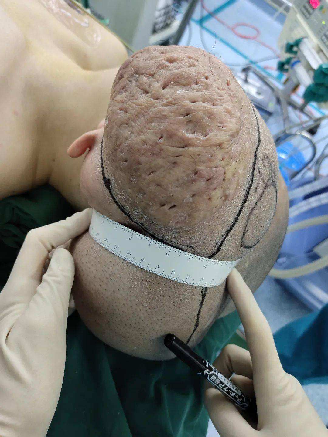 脑袋上长了3.4斤的巨大脂肪瘤,温州小伙20多年的