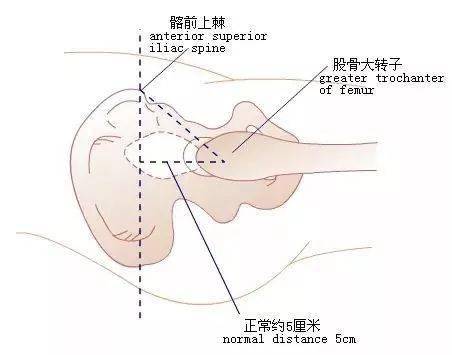 髋关节查体怎么做?