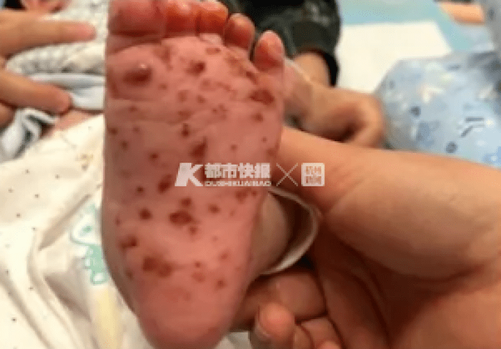病毒|感染了致命病毒！?东莞家长注意了！2个月大的婴儿因家人这个动作