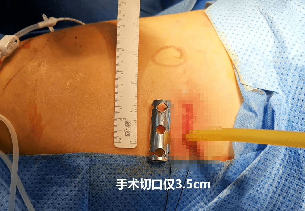 单孔胸腔镜下肋骨骨折胸腔内固定术切口