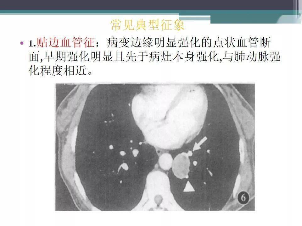 肺硬化性血管瘤psh影像表现