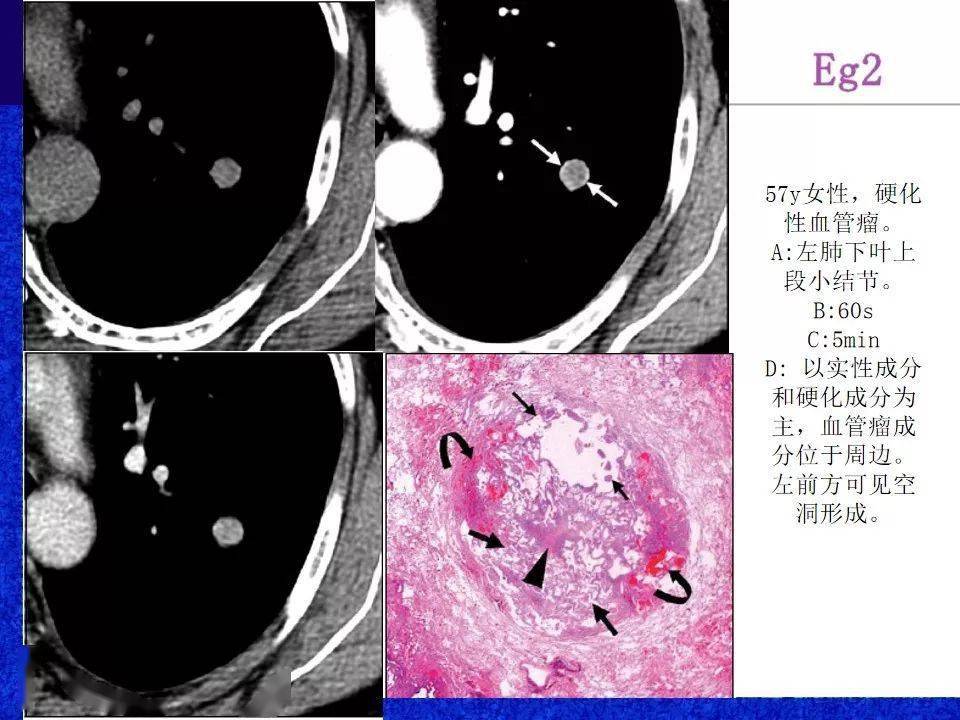 肺硬化性血管瘤psh影像表现