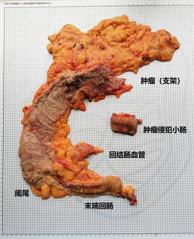 高血压61肠道支架置入状态61结肠肝曲恶性肿瘤伴梗阻术前诊断61