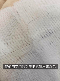 男婴吞下一根头发反复咳嗽七个月：常抓妈妈头发