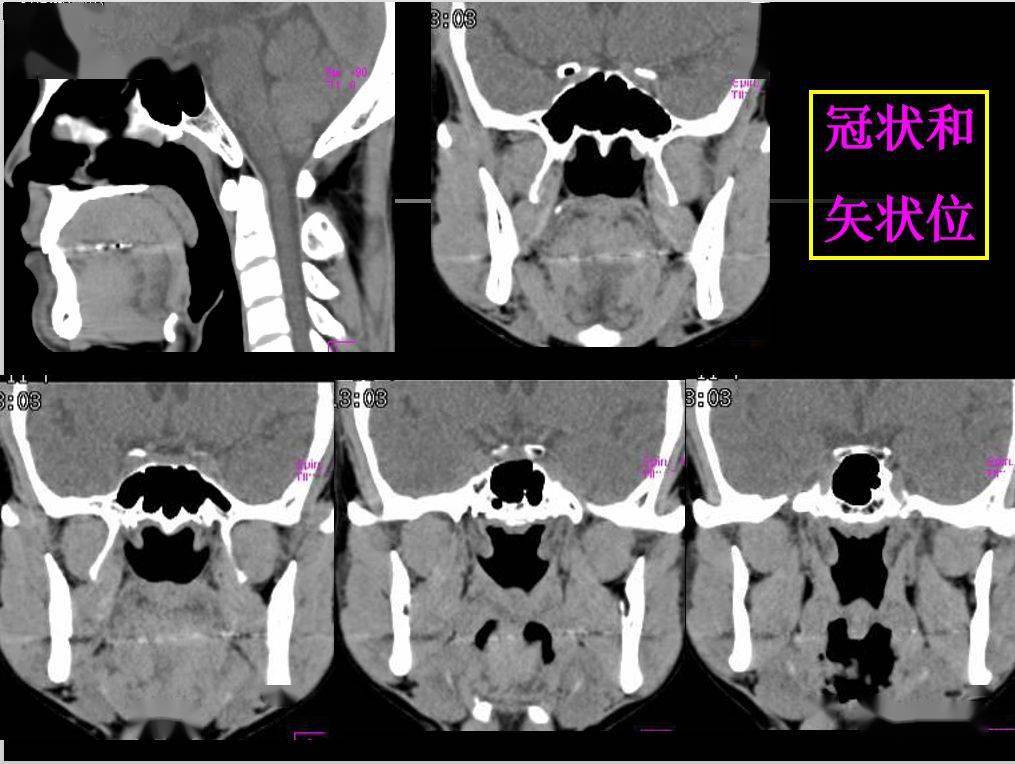 收藏必备鼻咽部的ct详细解剖