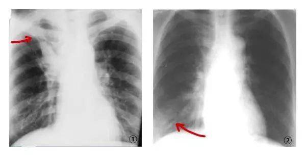 中央型肺癌的3大影像学征象