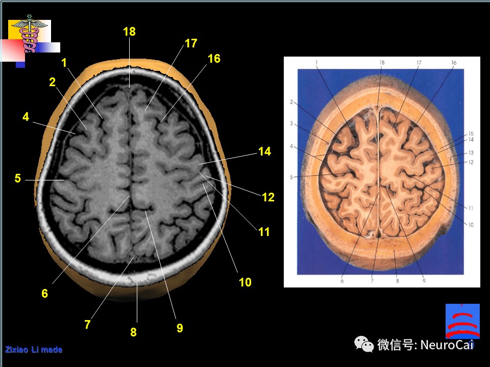 1,头皮 2,颅盖 3,硬膜 4,中央前回 5,中央沟 6,中央后回 7,蛛网膜下