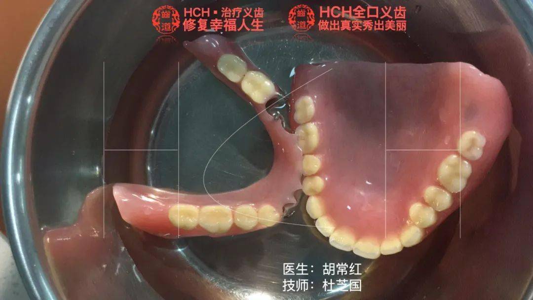 胡常红hch全口义齿每日临床分享012020年6月23日临床分享