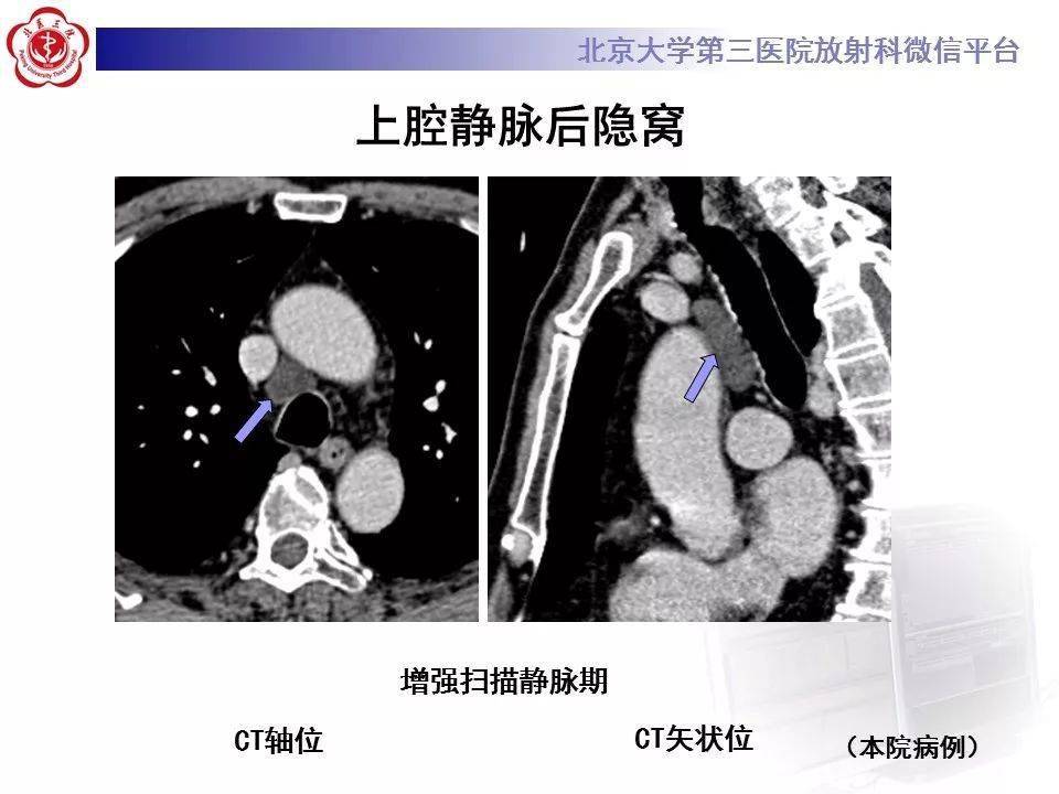 影像精美解剖丨心包窦及心包隐窝解剖建议收藏