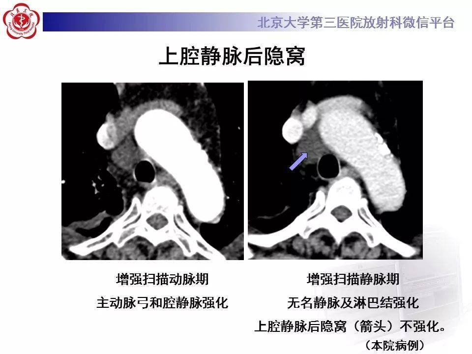 影像精美解剖丨心包窦及心包隐窝解剖,建议收藏!