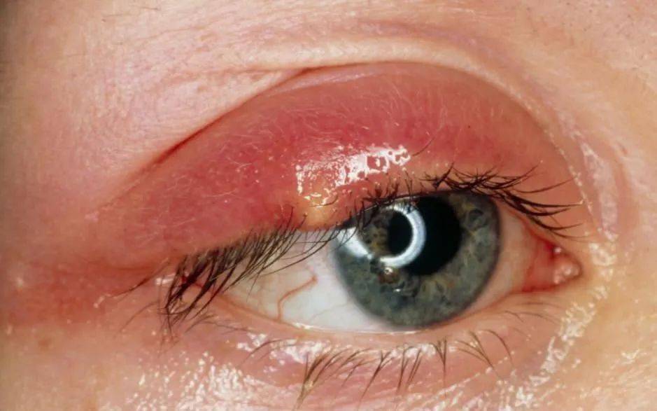 外睑腺炎的炎症反应主要位于睫毛根部的睑缘处,开始时眼睑红肿范围较