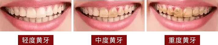 牙粉|爱笑的女人真美