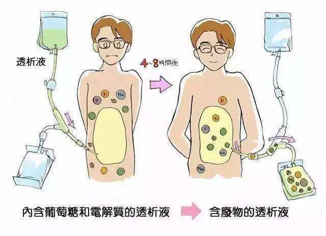 腹膜|短视频|治疗尿毒症的三大法宝