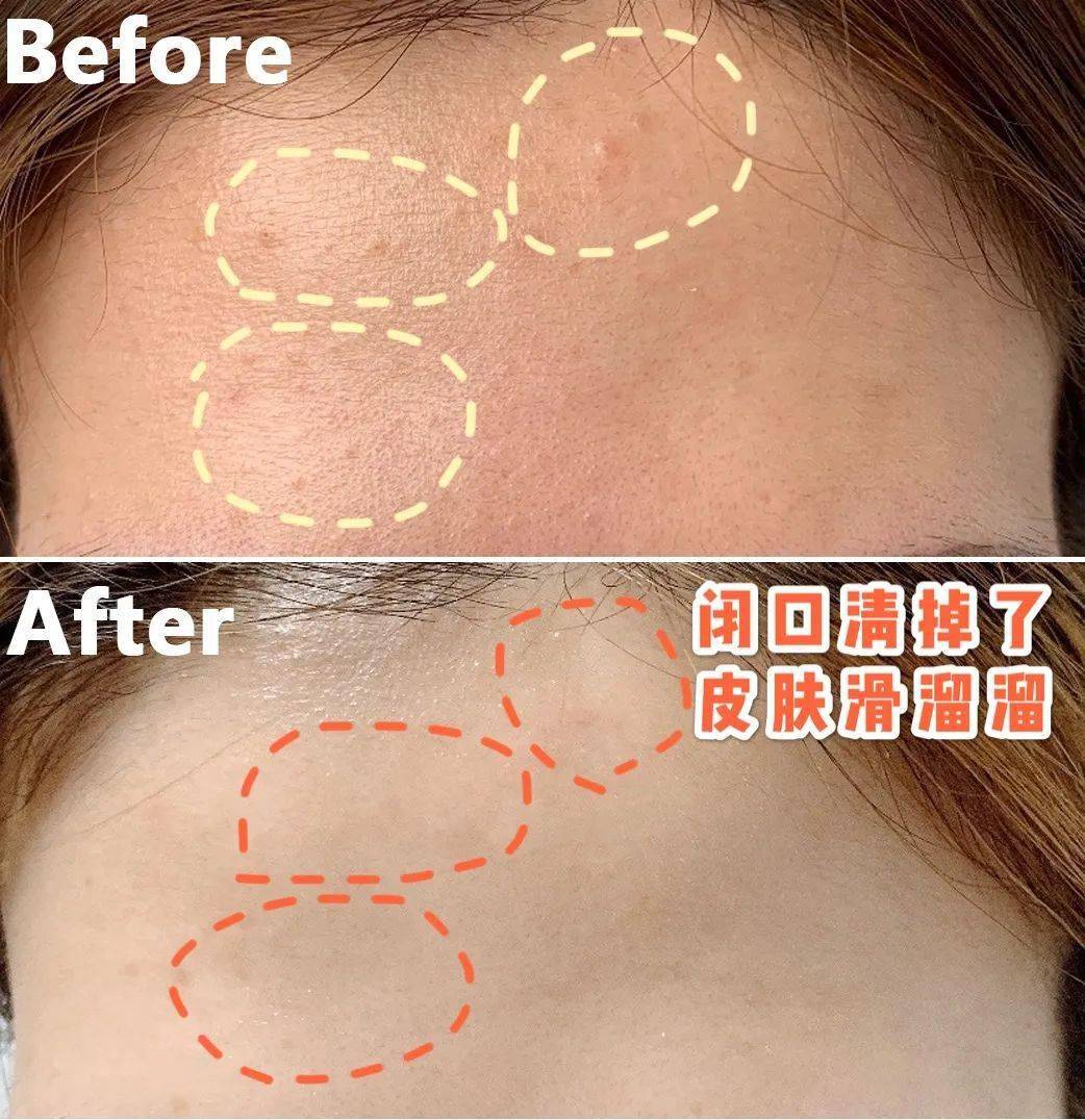 黑头|沈梦辰没骗我！HFP这些宝藏单品，真的让我“一夜换脸”！