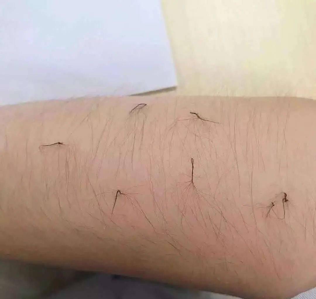 永久|疯狂抢！广东这家店99元永久脱毛！错过就亏大了！