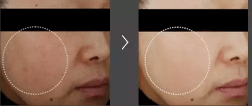 皮肤|用它点一点，痘印、斑点竟然没了，难怪李佳琦都为它疯狂打call！