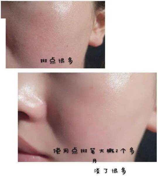 皮肤|用它点一点，痘印、斑点竟然没了，难怪李佳琦都为它疯狂打call！