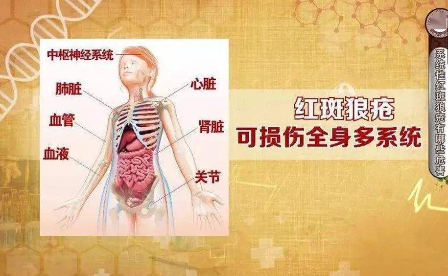 患者|【健康知识】与“狼”共舞，和谐相处