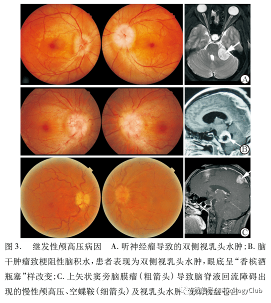 视盘水肿的现象,包括倾斜,拥挤视盘,视盘玻璃疣,有髓神经纤维等(图1)