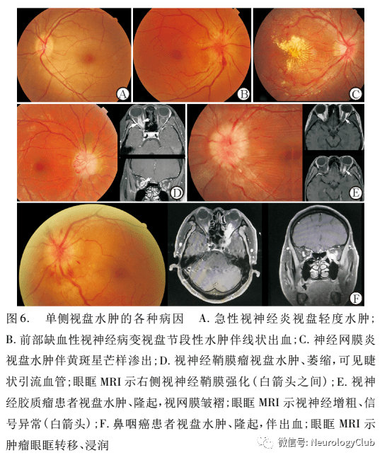 视盘水肿的现象,包括倾斜,拥挤视盘,视盘玻璃疣,有髓神经纤维等(图1)