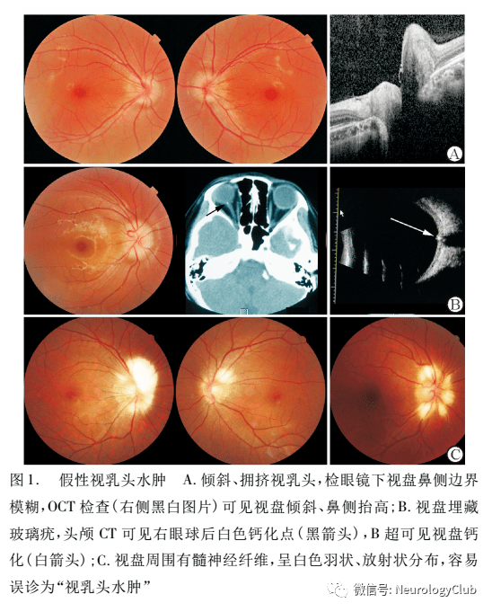 视盘水肿的现象,包括倾斜,拥挤视盘,视盘玻璃疣,有髓神经纤维等(图1)