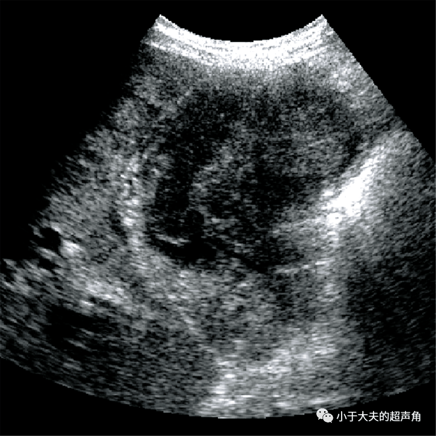 故为混合型~ 2,胆囊癌的超声造影表现是怎样的呢?