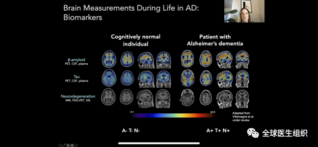 监测||必看|验血+脑PET可长期监测或早期确诊阿兹海默症