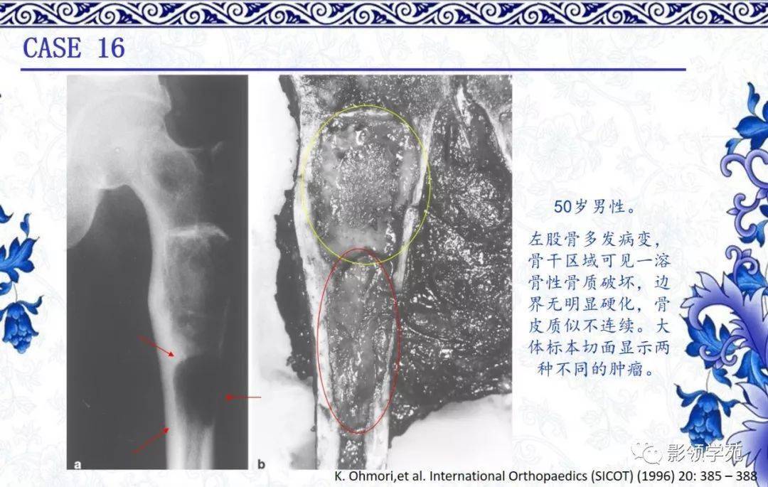 偶可见软骨,呈界限清楚的淡蓝色透明物质 镜下: 由纤维和骨性组织构成