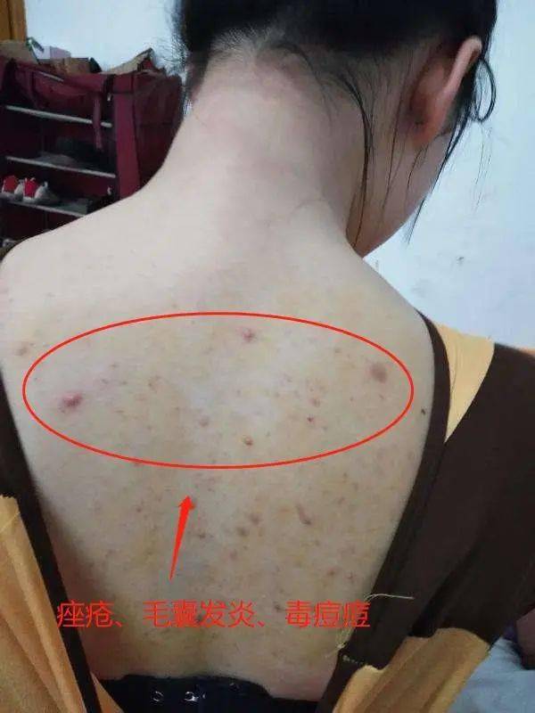 角质|薇娅吹爆的这款磨砂膏,我替你们试了,用完蚊子能在背上劈叉!