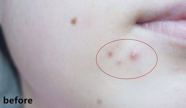 灭火器|1滴让你爱上!从满脸爆痘到光滑无瑕,我只用了这瓶火爆ins的“痘痘灭火器”!