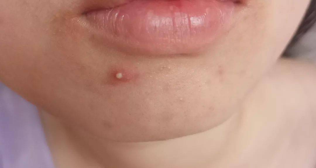 灭火器|1滴让你爱上!从满脸爆痘到光滑无瑕,我只用了这瓶火爆ins的“痘痘灭火器”!