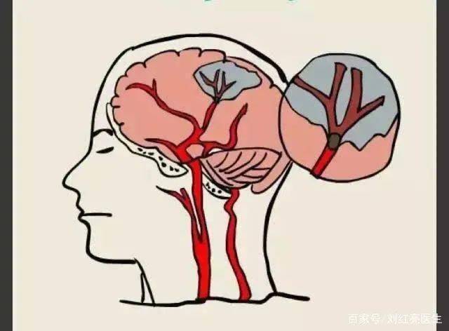 发病|【科普宣传】炎炎夏日，谨防脑卒中“偷袭”