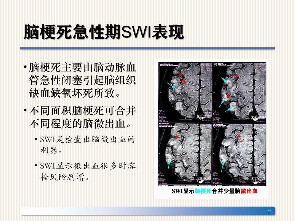 认识脑梗死