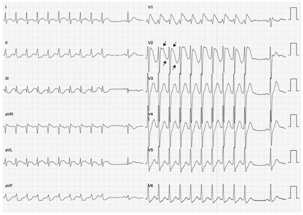 患者|这个房颤患者，让医生直呼“太惨了”……
