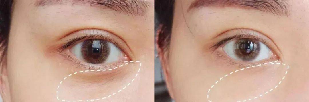 皱纹|抗皱抗衰老还在打针?用它赶走三八脸、鱼尾纹,让小朋友见到你都喊姐姐!