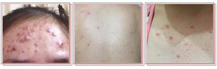 肌肤|脸上挤出的“白浆”是什么？原来是它作怪！出油、过敏也因此而起！