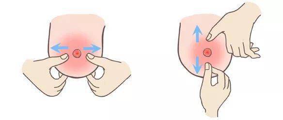 2. 乳头凹陷的产后矫正方法