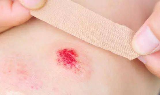 别忽视小伤口 赶快来看看如何科学处理伤口吧