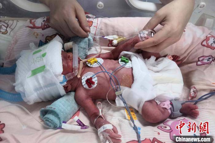 自然|湖北宜昌产妇诞下罕见龙凤四胞胎